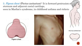 3. Pigeon chest (Pectus carinatum) : It is forward protrusion of
sternum and adjacent costal cartilage,
seen in Marfan’s syndrome, in childhood asthma and rickets
 