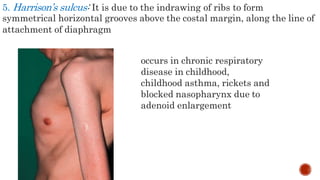 5. Harrison’s sulcus: It is due to the indrawing of ribs to form
symmetrical horizontal grooves above the costal margin, along the line of
attachment of diaphragm
occurs in chronic respiratory
disease in childhood,
childhood asthma, rickets and
blocked nasopharynx due to
adenoid enlargement
 