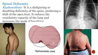 Spinal Deformity
Kyphoscoliosis : It is a disfiguring or
disabling deformity of the spine, producing a
shift of the apex beat. It reduces the
ventilatory capacity of the lung and
increases the work of breathing.
 