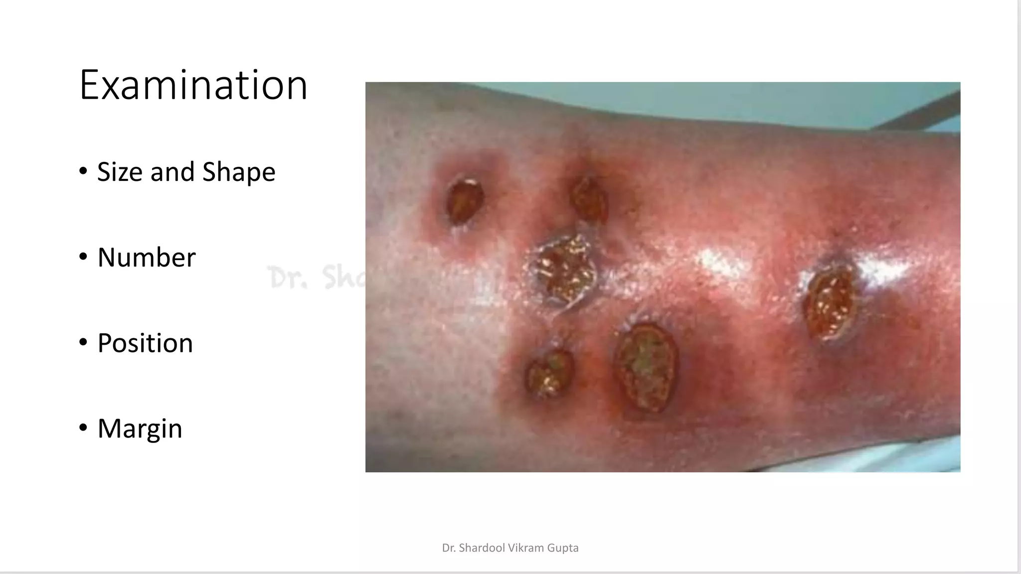 Examination
• Size and Shape
• Number
• Position
• Margin
Dr. Shardool Vikram Gupta
 