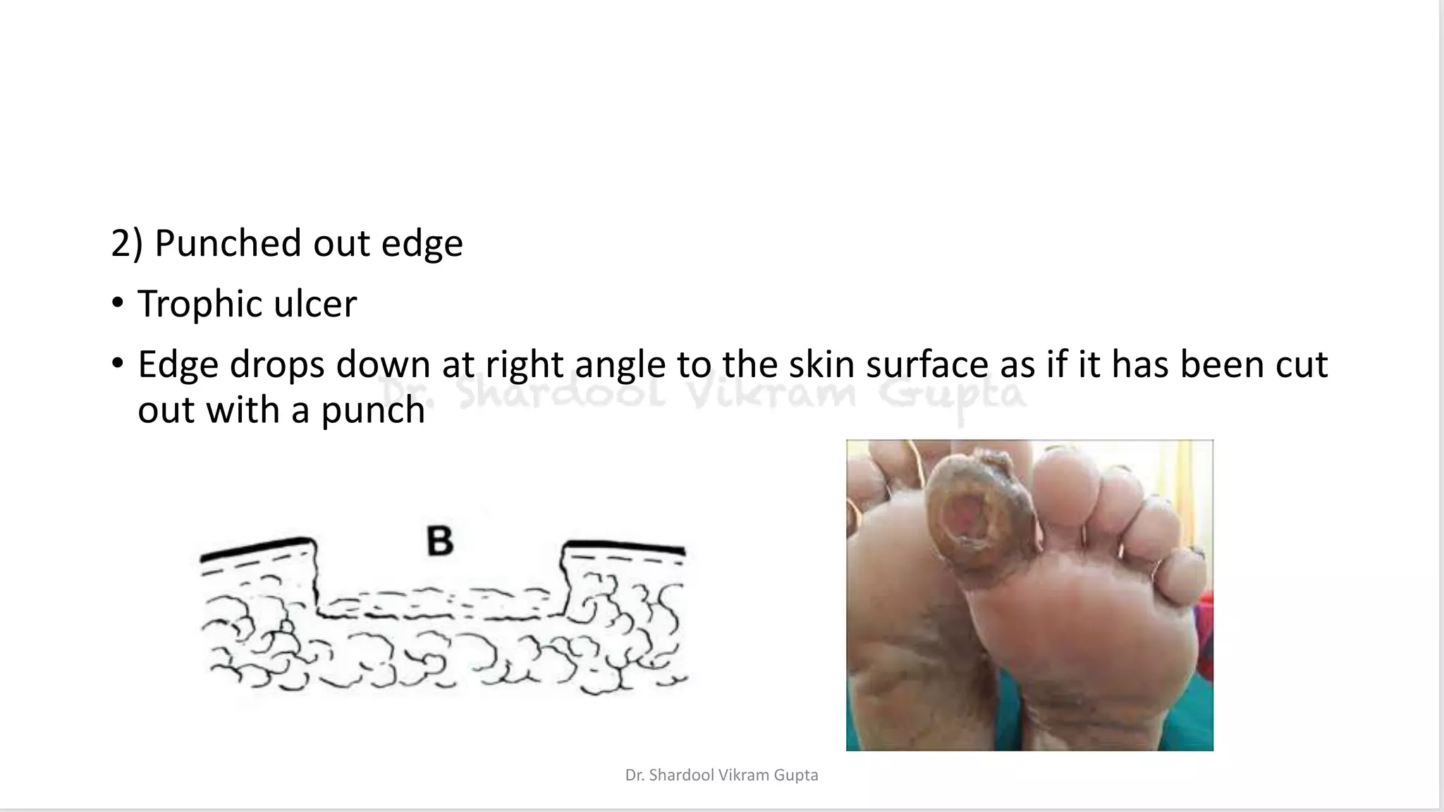 2) Punched out edge
• Trophic ulcer
• Edge drops down at right angle to the skin surface as if it has been cut
out with a punch
Dr. Shardool Vikram Gupta
 