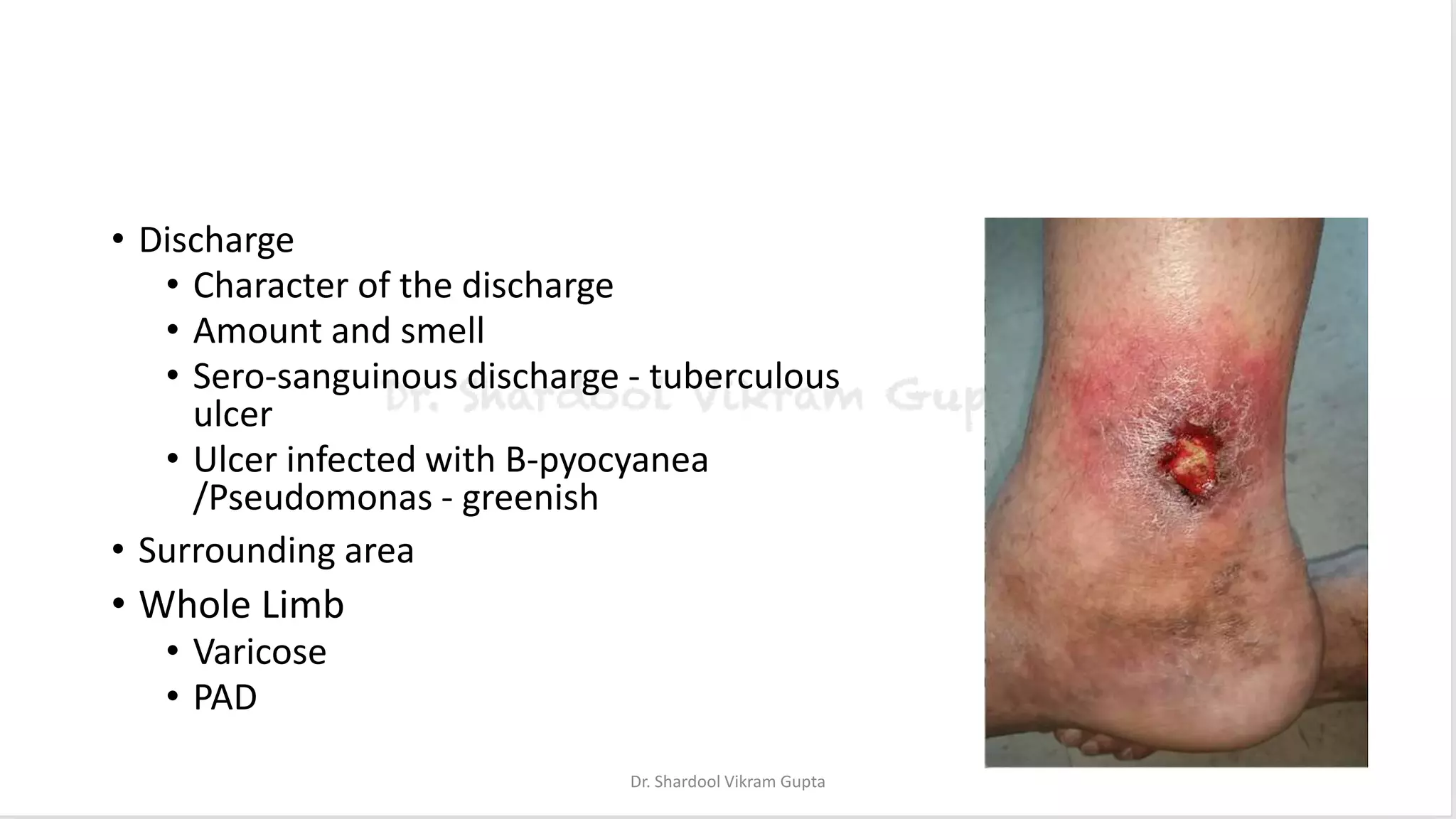 • Discharge
• Character of the discharge
• Amount and smell
• Sero-sanguinous discharge - tuberculous
ulcer
• Ulcer infected with B-pyocyanea
/Pseudomonas - greenish
• Surrounding area
• Whole Limb
• Varicose
• PAD
Dr. Shardool Vikram Gupta
 