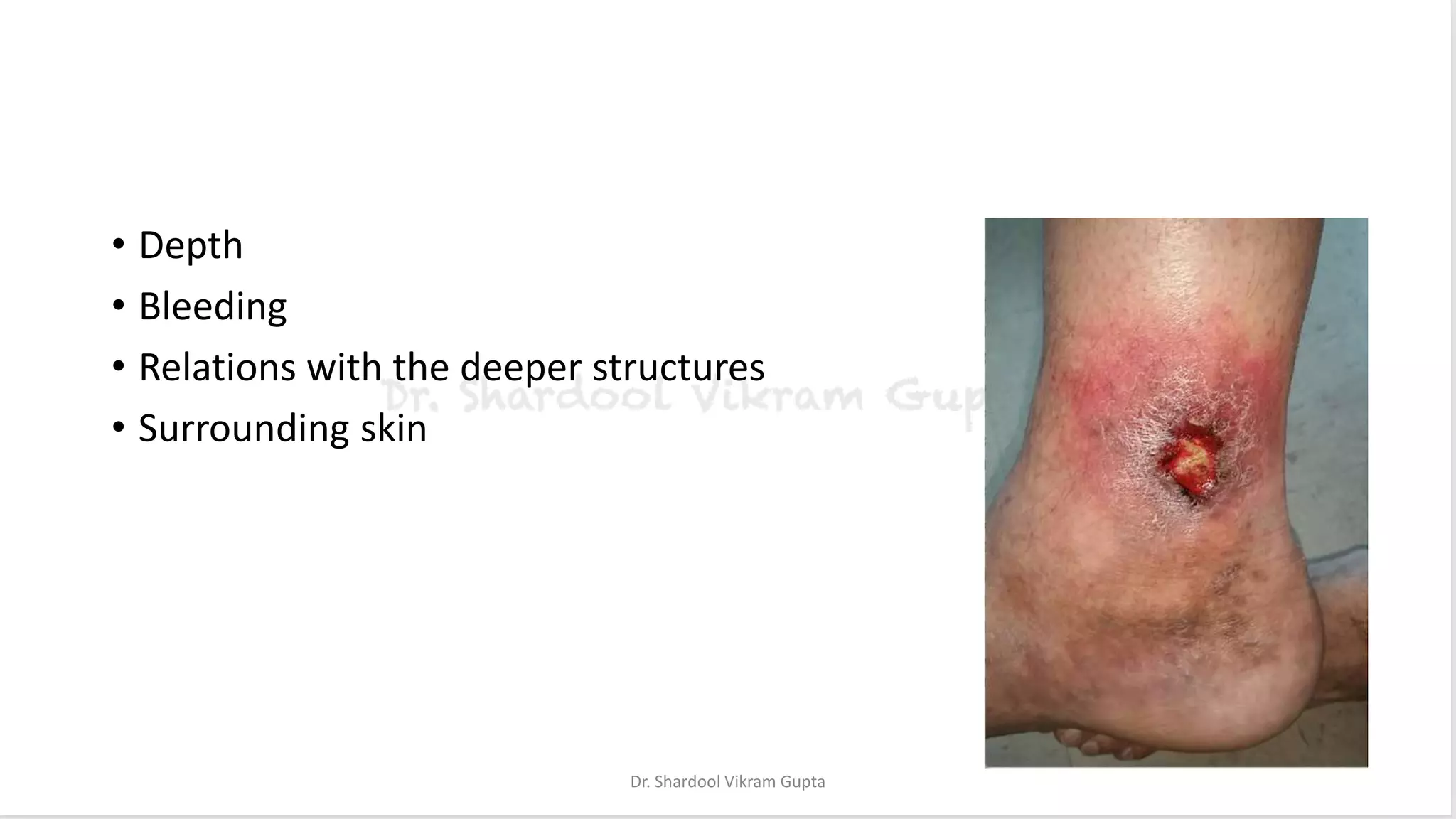 • Depth
• Bleeding
• Relations with the deeper structures
• Surrounding skin
Dr. Shardool Vikram Gupta
 
