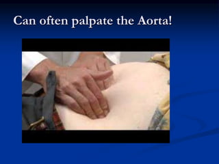 Can often palpate the Aorta!
 