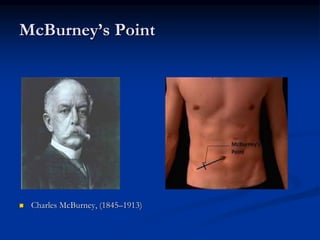 McBurney’s Point
 Charles McBurney, (1845–1913)
 