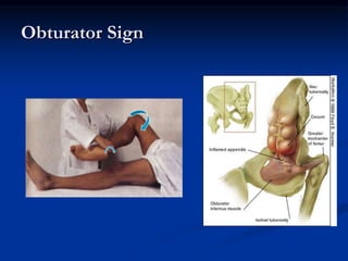 Obturator Sign
 