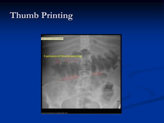 Thumb Printing
 