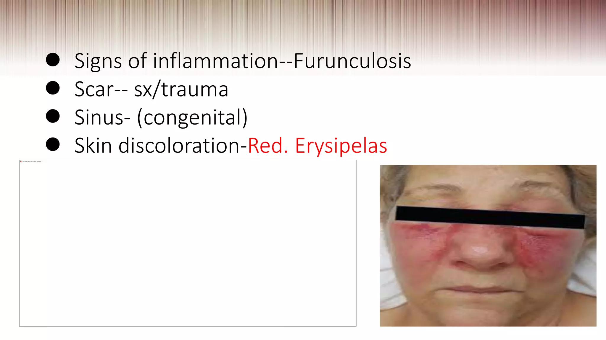  Signs of inflammation--Furunculosis
 Scar-- sx/trauma
 Sinus- (congenital)
 Skin discoloration-Red. Erysipelas
 