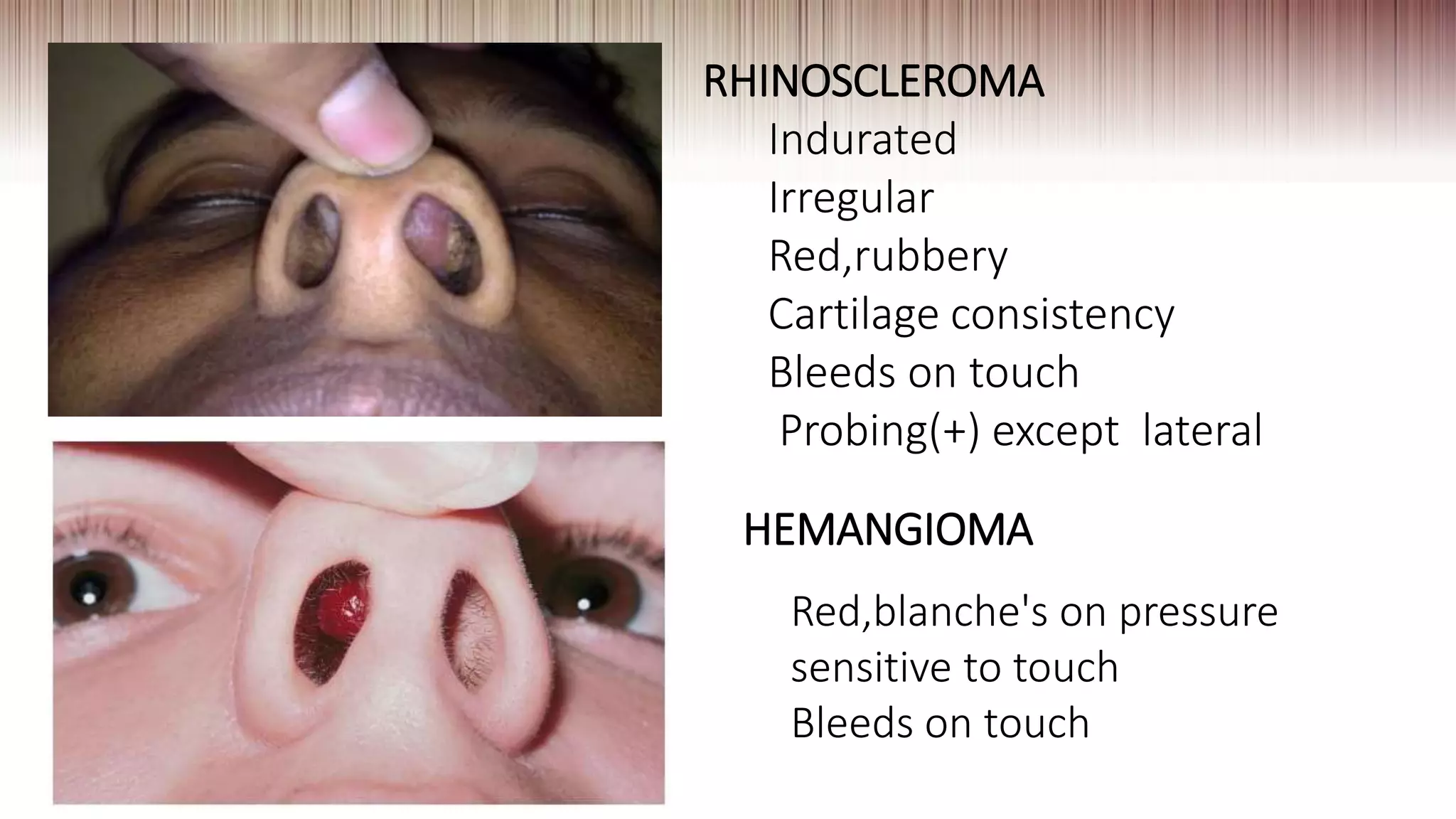 RHINOSCLEROMA
Indurated
Irregular
Red,rubbery
Cartilage consistency
Bleeds on touch
Probing(+) except lateral
HEMANGIOMA
Red,blanche's on pressure
sensitive to touch
Bleeds on touch
 