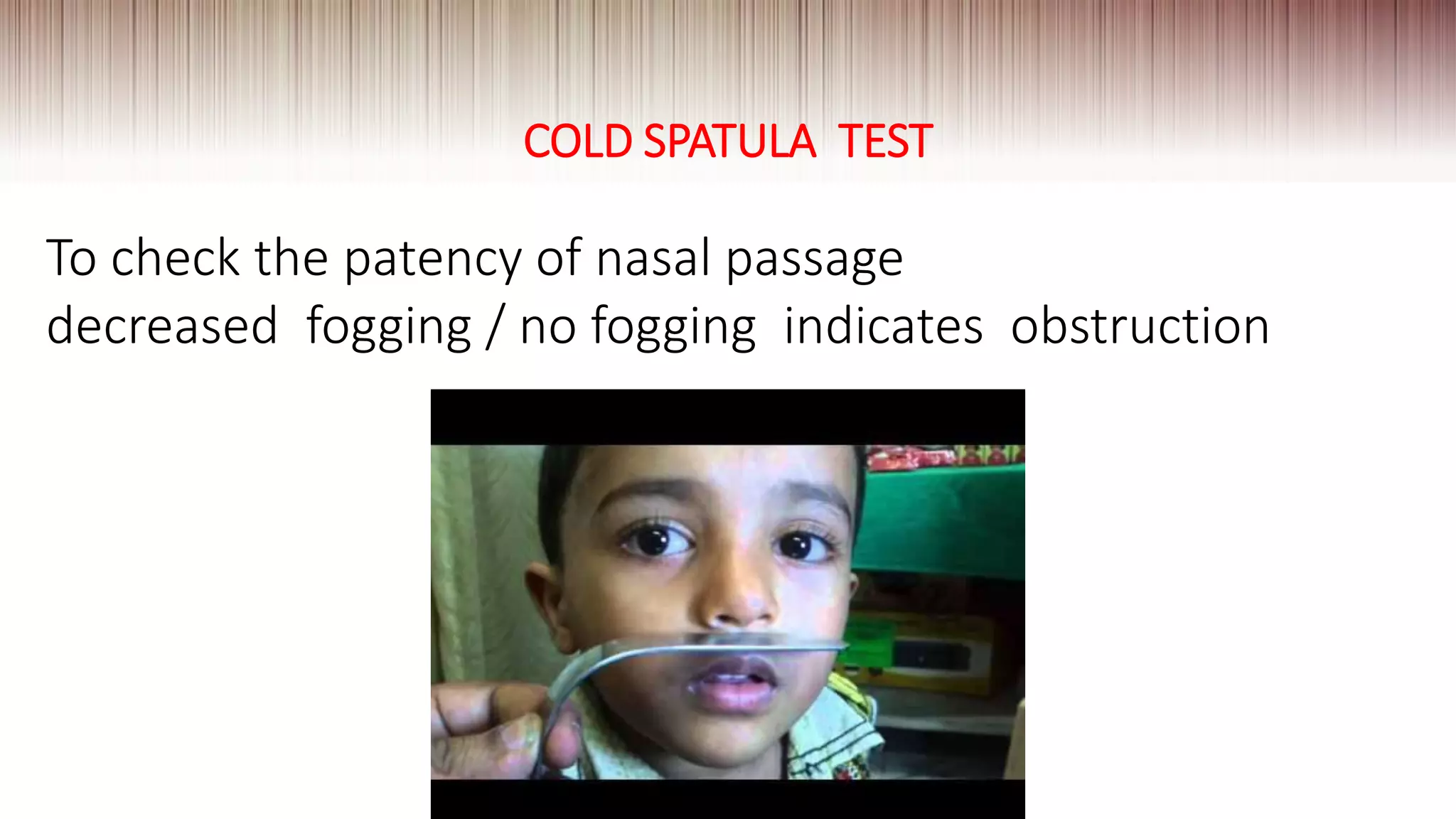 COLD SPATULA TEST
To check the patency of nasal passage
decreased fogging / no fogging indicates obstruction
 