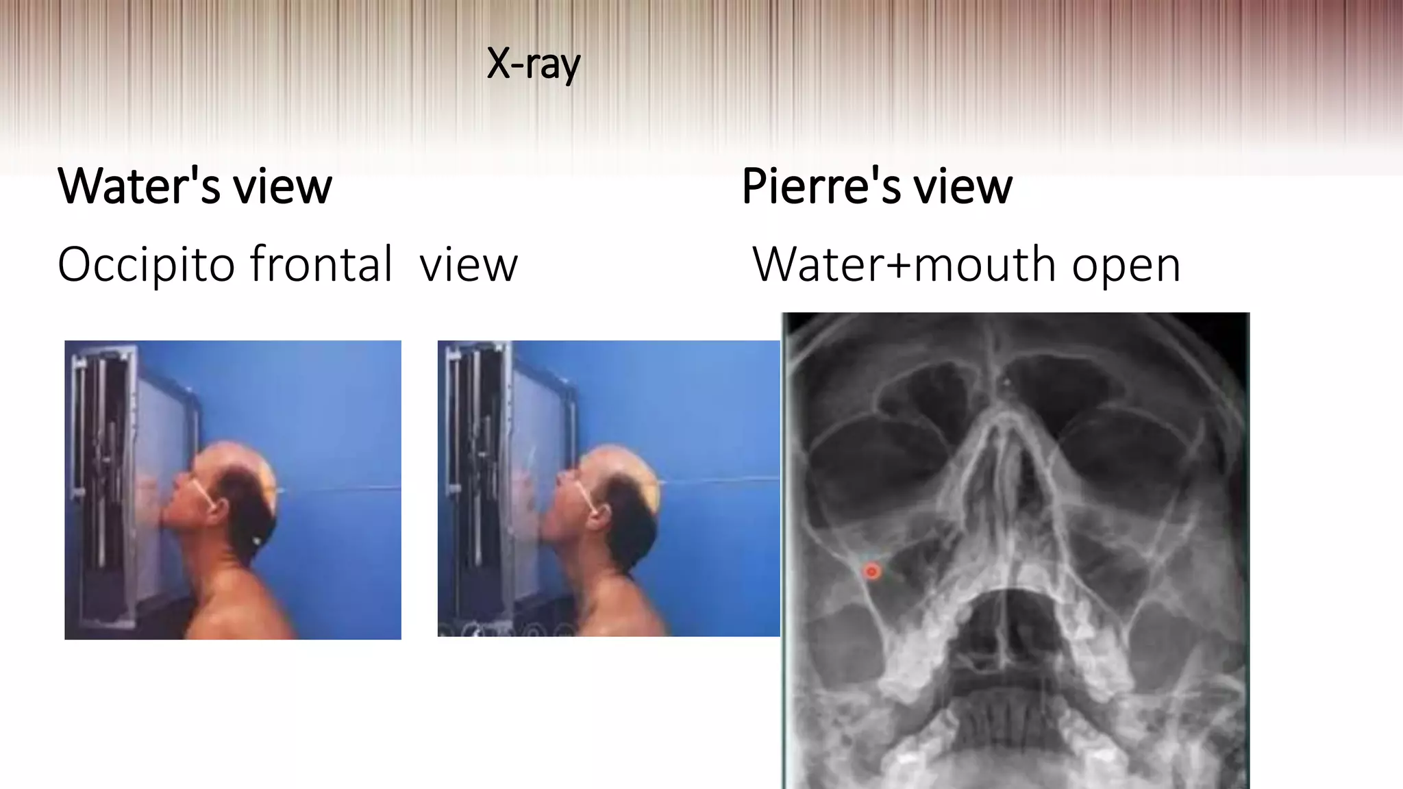 X-ray
Water's view
Occipito frontal view
Pierre's view
Water+mouth open
 