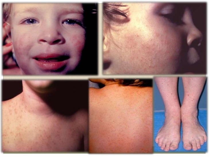 Exantema de boston, coxsackie, echo9 y 11, enterovirus