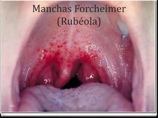 Manchas Forcheimer 
(Rubéola) 
 