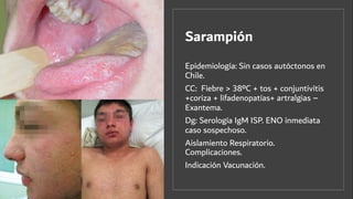 Sarampión
Epidemiología: Sin casos autóctonos en
Chile.
CC: Fiebre > 38ºC + tos + conjuntivitis
+coriza + lifadenopatías+ artralgias –
Exantema.
Dg: Serología IgM ISP. ENO inmediata
caso sospechoso.
Aislamiento Respiratorio.
Complicaciones.
Indicación Vacunación.
 