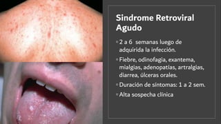 Sindrome Retroviral
Agudo
◦ 2 a 6 semanas luego de
adquirida la infección.
◦ Fiebre, odinofagia, exantema,
mialgias, adenopatías, artralgias,
diarrea, úlceras orales.
◦ Duración de síntomas: 1 a 2 sem.
◦ Alta sospecha clínica
 