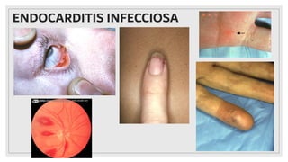 ENDOCARDITIS INFECCIOSA
 