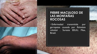 FIEBRE MACULOSO DE
LAS MONTAÑAS
ROCOSAS
◦ Enfermedad transmitida por
garrapatas causada por Rickettsia
rickettsii . Sureste EEUU, Mex,
Brasil.
 