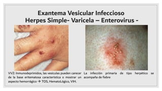 Exantema Vesicular Infeccioso
Herpes Simple- Varicela – Enterovirus -
VVZ: Inmunodeprimidos, las vesículas pueden carecer
de la base eritematosa característica o mostrar un
aspecto hemorrágico à TOS, HematoLógico, VIH.
La infección primaria de tipo herpético se
acompaña de ﬁebre
 