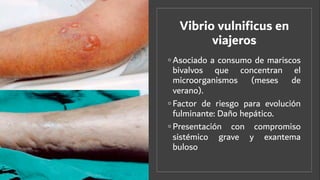Vibrio vulniﬁcus en
viajeros
◦ Asociado a consumo de mariscos
bivalvos que concentran el
microorganismos (meses de
verano).
◦ Factor de riesgo para evolución
fulminante: Daño hepático.
◦ Presentación con compromiso
sistémico grave y exantema
buloso
 