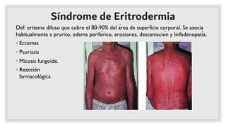 Síndrome de Eritrodermia
◦ Eccemas
◦ Psoriasis
◦ Micosis fungoide.
◦ Reacción
farmacológica.
Def: eritema difuso que cubre el 80-90% del área de superficie corporal. Se asocia
habitualmente a prurito, edema períférico, erosiones, descamación y linfadenopatía.
 