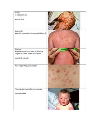 Viruela
Sí dejacicatrices.
Variola virus
Sarampión
Virusdel sarampión (géneromorbillivirus)
Rubéola
Aparece primeroencara y se dispersa
luegohaciaotras partesdel cuerpo.
Virusde la rubeola
Roséolaporherpesvirus tipo 6
Eritemainfecciosoo5ta enfermedad
ParvovirusB19