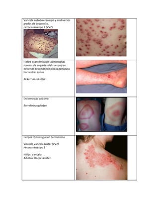 Varicelaentodoel cuerpoy endiversos
grados de desarrollo.
Herpes virustipo 3 (VVZ)
Fiebre exantémicade lasmontañas
rocosas da enpartesdel cuerpoy se
extiendedesdedonde picólagarrapata
hacia otras zonas
Rickettsia rickettsii
Enfermedadde Lyme
Borrelia burgdorferi
Herpeszóstersigue undermatoma
Virusde VaricelaZóster(VVZ)
Herpes virustipo 3
Niños:Varicela
Adultos:HerpesZoster