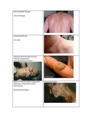 Enfermedaddel dengue
Virusdel dengue
Enfermedadde Zika
VirusZika
Papiloma,áreasde todoel cuerpo,
incluidoáreasgenitales
Virusdel papiloma humano
Lepra,en todoel cuerpoy la gravedad
depende si estipotuberculosoo
lepromatoso
Mycobacteriumleprae
Lepra lepromatosa