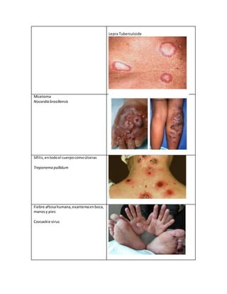 Lepra Tuberculoide
Micetoma
Nocardia brasiliensis
Sífilis,entodoel cuerpocomoúlceras
Treponema pallidum
Fiebre aftosahumana,exantemaenboca,
manosy pies
Coxsackie virus