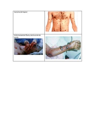 Sarcoma de Kaposi
Enfermedaddel Ébola,destrucciónde
tejido