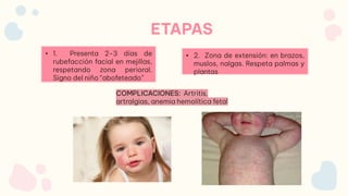 • 1. Presenta 2-3 días de
rubefacción facial en mejillas,
respetando zona perioral.
Signo del niño “abofeteado”
• 2. Zona de extensión: en brazos,
muslos, nalgas. Respeta palmas y
plantas
ETAPAS
COMPLICACIONES: Artritis,
artralgias, anemia hemolítica fetal
 