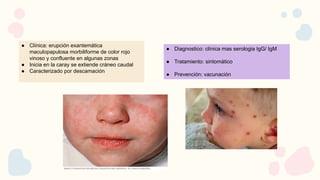 ● Clínica: erupción exantemática
maculopapulosa morbiliforme de color rojo
vinoso y confluente en algunas zonas
● Inicia en la caray se extiende cráneo caudal
● Caracterizado por descamación
● Diagnostico: clínica mas serologia IgG/ IgM
● Tratamiento: sintomático
● Prevención: vacunación
 