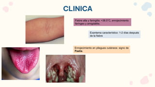 CLINICA
Fiebre alta y faringitis: +38.5°C, enrojecimiento
faríngeo y amigdalitis.
Exantema característico: 1-2 días después
de la fiebre
Enrojecimiento en pliegues cutáneos: signo de
Pastia.
 