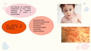Las lesiones se manifiestan
inicialmente en cara, cuero
cabelludo con posterior
extensión a tronco y
extremidades
Complicaciones:
Infecciones bacterianas
de la piel, ataxia
cerebelosa,
meningoencefalitis,
neumonitis,
trombocitopenia
Las lesiones se
caracterizan por ser
pruriginosas
 