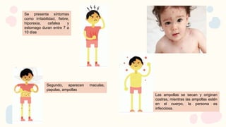 Se presenta síntomas
como irritabilidad, fiebre,
hiporexia, cefalea y
estomago duran entre 7 a
10 días
Segundo, aparecen maculas,
papulas, ampollas
Las ampollas se secan y originan
costras, mientras las ampollas estén
en el cuerpo, la persona es
infecciosa.
 