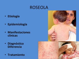 Exantema Subito O Roseola Infantil