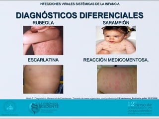 INFECCIONES VIRALES SISTÉMICAS DE LA INFANCIA



DIAGNÓSTICOS DIFERENCIALES
       RUBEOLA                                                            SARAMPIÓN




   ESCARLATINA                                          REACCIÓN MEDICOMENTOSA.




  Hirsh T. Diagnóstico diferencial de Exantemas. Tomado de www.urgenciauc.com/profesion/pdf/Exantemas_Pediatria.pdfel 20/2/2008
 