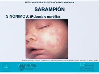 INFECCIONES VIRALES SISTÉMICAS DE LA INFANCIA



                             SARAMPIÓN
SINÓNIMOS: (Rubeola o morbilia)




         Bielsa I. Infecciones por virus. En: Ferrándiz C, editor. Dermatología clínica. Madrid: Ediciones Harcourt S.A.; 2007. p. 45-61.
 