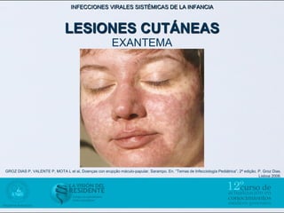 INFECCIONES VIRALES SISTÉMICAS DE LA INFANCIA



                               LESIONES CUTÁNEAS
                                                         EXANTEMA




GROZ DIAS P, VALENTE P, MOTA L et al, Doenças con erupçâo máculo-papular. Sarampo. En. “Temas de Infecciología Pediátrica”. 2ª ediçâo. P. Groz Dias.
                                                                                                                                       Lisboa 2006.
 