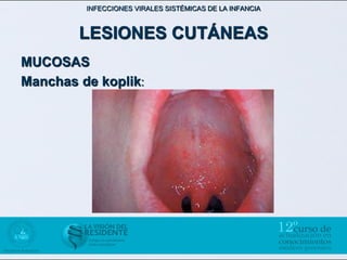 INFECCIONES VIRALES SISTÉMICAS DE LA INFANCIA



        LESIONES CUTÁNEAS
MUCOSAS
Manchas de koplik:
 