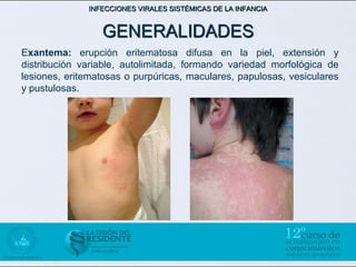 INFECCIONES VIRALES SISTÉMICAS DE LA INFANCIA


                 GENERALIDADES
Exantema: erupción eritematosa difusa en la piel, extensión y
distribución variable, autolimitada, formando variedad morfológica de
lesiones, eritematosas o purpúricas, maculares, papulosas, vesiculares
y pustulosas.
 