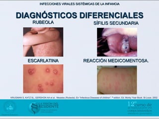 INFECCIONES VIRALES SISTÉMICAS DE LA INFANCIA



    DIAGNÓSTICOS DIFERENCIALES
                     RUBEOLA                                                    SÍFILIS SECUNDARIA




                ESCARLATINA                                           REACCIÓN MEDICOMENTOSA.




KRUGMAN S, KATZ SL, GERSHON AA et al, Measles (Rubeola). En “Infectious Diseases of children”. th edition. Ed. Morby Year Book. St Louis. 2002
 
