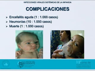 INFECCIONES VIRALES SISTÉMICAS DE LA INFANCIA



               COMPLICACIONES
   Encefalitis aguda (1 : 1.000 casos)
   Neumonías (10 : 1.000 casos)
   Muerte (1 : 1.000 casos)
 
