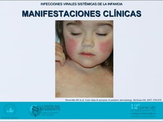 INFECCIONES VIRALES SISTÉMICAS DE LA INFANCIA


MANIFESTACIONES CLÍNICAS




                Show-Mei KK et al. Color atlas & synopsis of pediatric dermatology. McGraw-Hill; 2007: 578-579
 