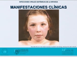 INFECCIONES VIRALES SISTÉMICAS DE LA INFANCIA



MANIFESTACIONES CLÍNICAS




                Show-Mei KK et al. Color atlas & synopsis of pediatric dermatology. McGraw-Hill; 2007: 578-579
 