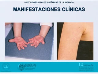 INFECCIONES VIRALES SISTÉMICAS DE LA INFANCIA



MANIFESTACIONES CLÍNICAS
 