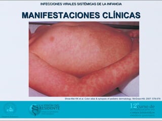 INFECCIONES VIRALES SISTÉMICAS DE LA INFANCIA



MANIFESTACIONES CLÍNICAS




                Show-Mei KK et al. Color atlas & synopsis of pediatric dermatology. McGraw-Hill; 2007: 578-579
 