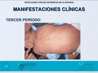 INFECCIONES VIRALES SISTÉMICAS DE LA INFANCIA



   MANIFESTACIONES CLÍNICAS

TERCER PERÍODO:
 