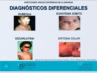 INFECCIONES VIRALES SISTÉMICAS DE LA INFANCIA


DIAGNÓSTICOS DIFERENCIALES
  RUBEOLA                                        EXANTEMA SÚBITO




 ESCARLATINA                                        ERITEMA SOLAR




                Behrman RE, Kliegman RM. Nelson textbook of pediatrics. 16th ed. WB Saunders Co.; 2005: 964-966.
 