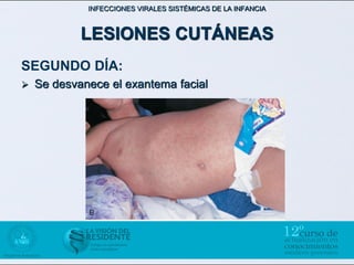 INFECCIONES VIRALES SISTÉMICAS DE LA INFANCIA



            LESIONES CUTÁNEAS
SEGUNDO DÍA:
   Se desvanece el exantema facial
 