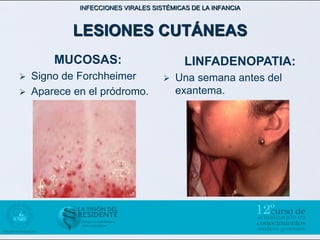INFECCIONES VIRALES SISTÉMICAS DE LA INFANCIA



            LESIONES CUTÁNEAS
        MUCOSAS:                          LINFADENOPATIA:
   Signo de Forchheimer               Una semana antes del
   Aparece en el pródromo.             exantema.
 